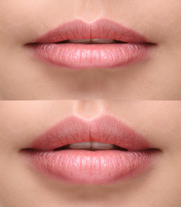 Lip filler Dublin Happy Woman Clinic