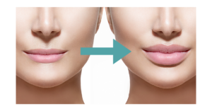 lip filler