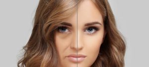 Nasolabial folds treatment Dublin Happy Woman Clinic