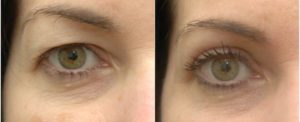 Eye Lift