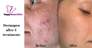 Dermapen Dublin Happy Woman Clinic