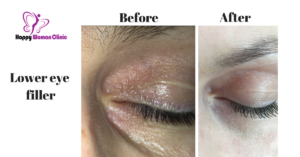 lower eye filler slide