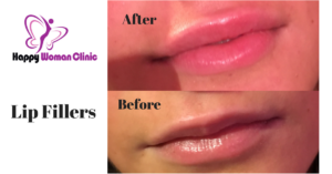 Lip Fillers Dublin