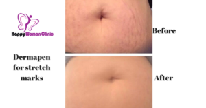 Dermapen Stretch mark removal happy woman clinic dublin